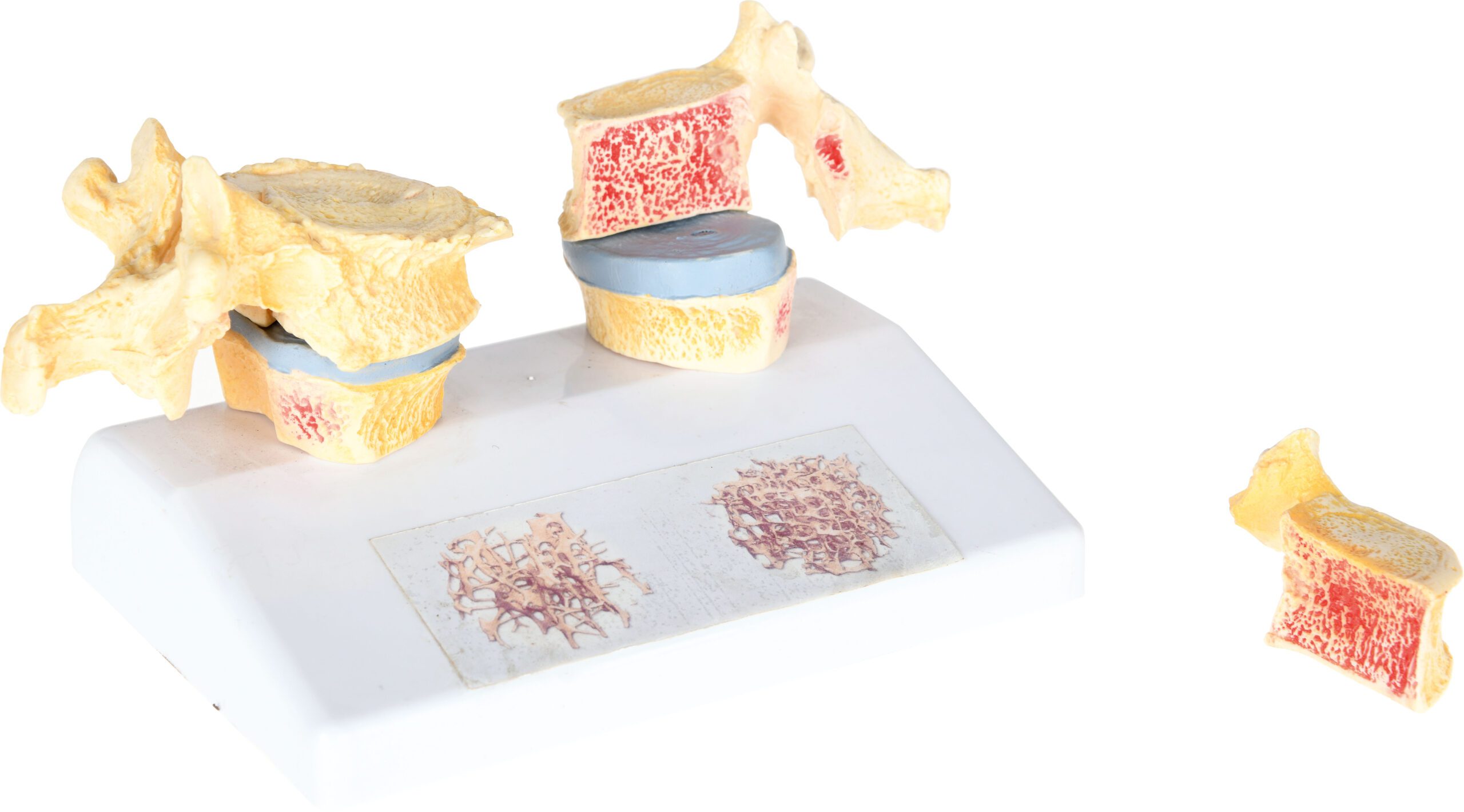 osteoporozes-modelis-571179-main Osteoporozės modelis 571179 - Image 1